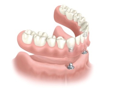 Dental Implants