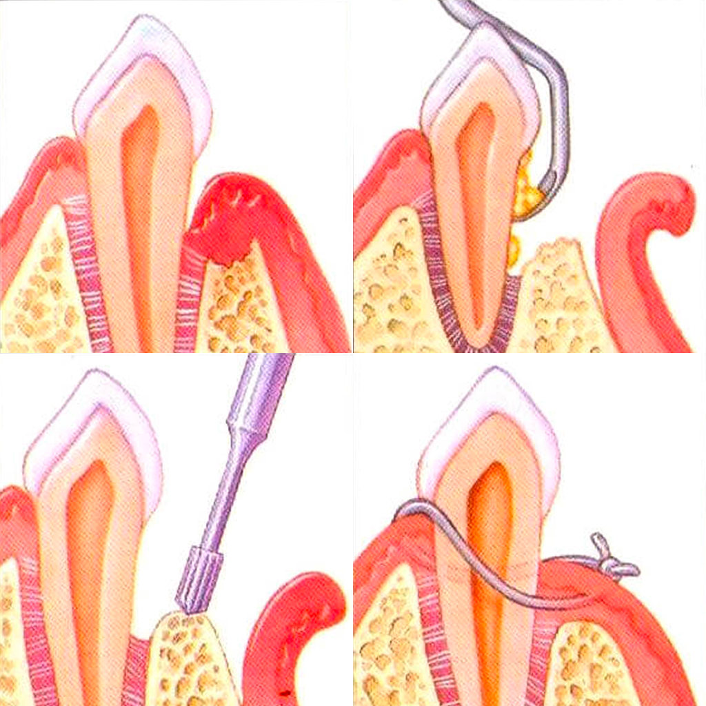 services-periodontal-flap-surgery